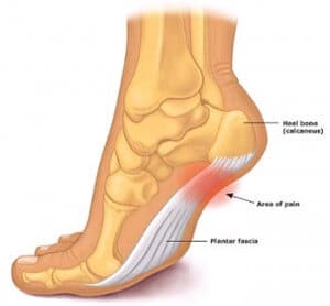 Plantar Fascia treatment Cranberry